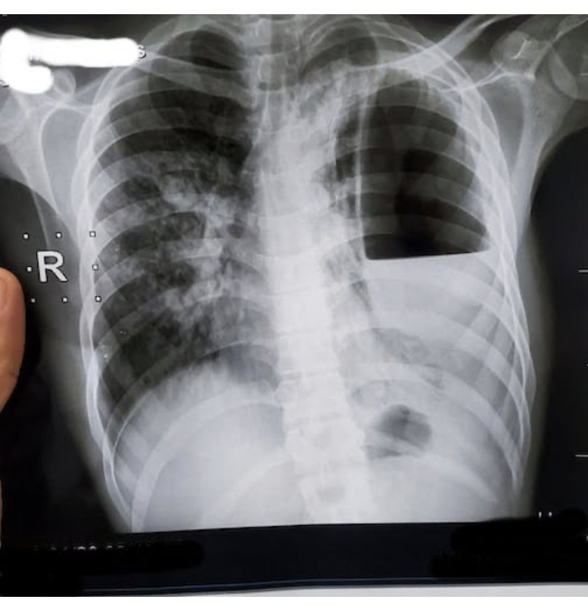 DrMedica_13's tweet image. Radiology ✨

“What are the #Positive_Finding in this Chest #X_ray?”