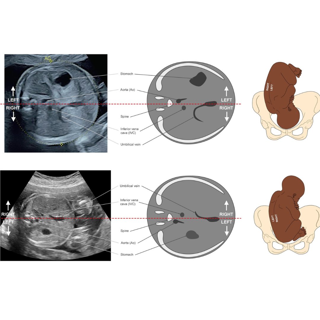 Enrol in our new basic training online program to explore fundamental ultrasound topics in #OBGYN. Embark on 30 hours of self-paced interactive learning to enhance your competence, independence and effectiveness in using ultrasound #LoveUltrasound bit.ly/4885orc