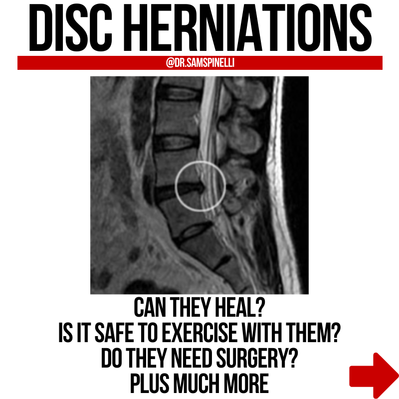 Let's talk about disc herniations. Thread from Samuel Spinelli
