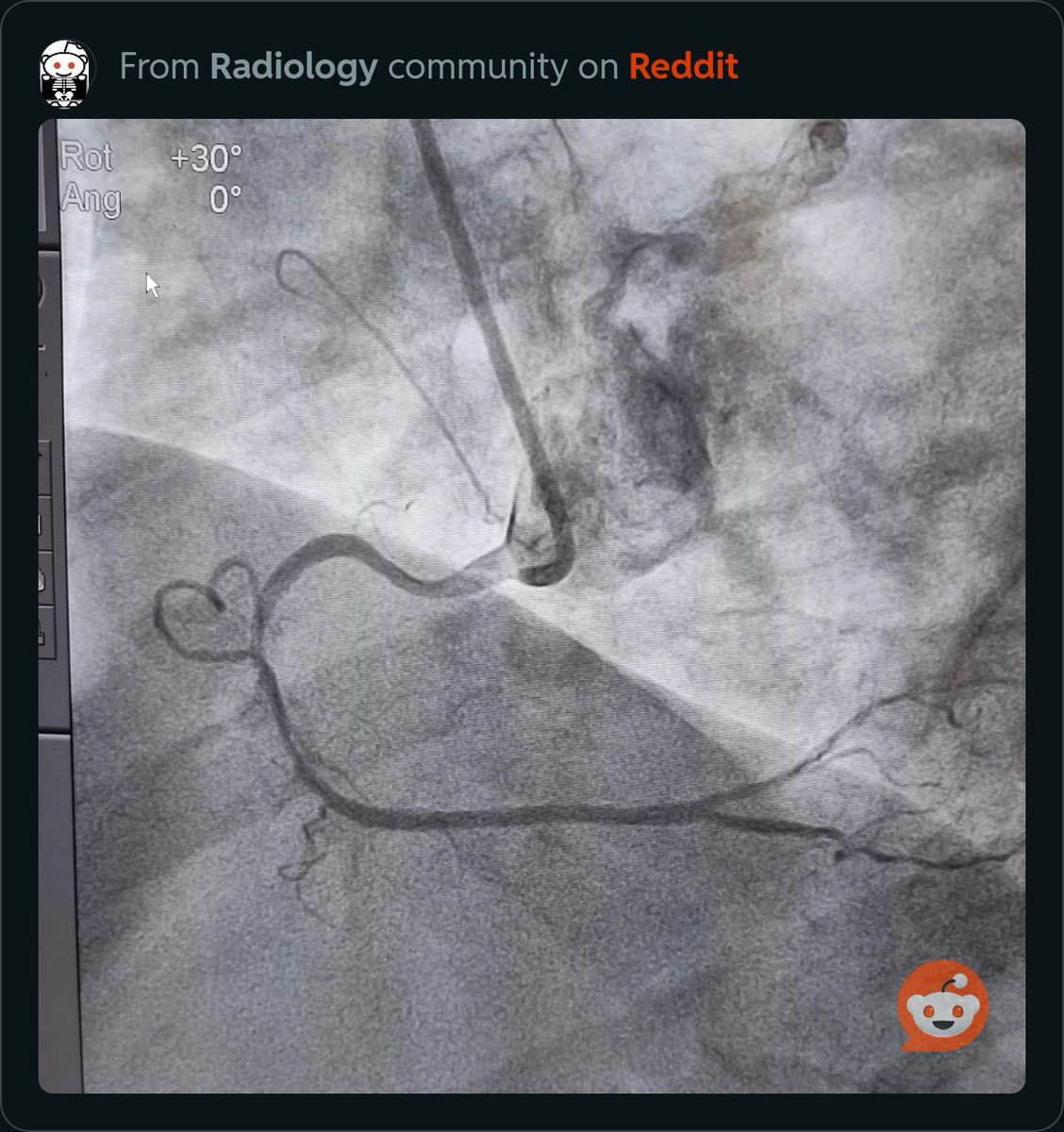radRounds's tweet photo. What organ is this vessel located in?  Bonus: what vessel and diagnosis?  Hint is on the image. https://t.co/X4oRO0pB6L