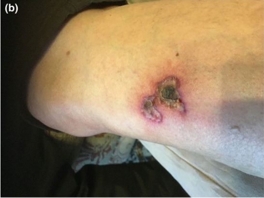 mRNAdeaths's tweet photo. Cutaneous thrombosis associated with skin necrosis following  1st dose #AstraZeneca vaccine.
https://t.co/LXPwGG0fQW https://t.co/V5bMi8Aofi