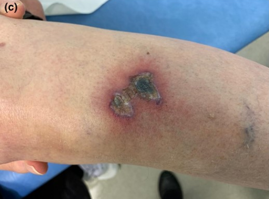 mRNAdeaths's tweet photo. Cutaneous thrombosis associated with skin necrosis following  1st dose #AstraZeneca vaccine.
https://t.co/LXPwGG0fQW https://t.co/V5bMi8Aofi