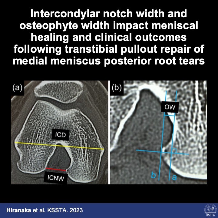 KSSTA's tweet photo. Width of the the intercondylar notch as well as preexisting osteophytes might impact meniscal healing.

#meniscus #repair #knee #osteophytes #notch #arthroscopy #healing

Read here: https://t.co/iw3oo4ezDD https://t.co/2DtKdw114O