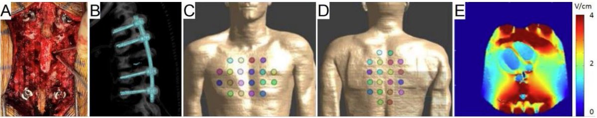CPatel_Lab's tweet image. A #commentary (academic.oup.com/noa/advance-ar…) on using bone removal and spinal implants as waveguides to enhance the field strength of #TTFields for bony spinal #metastasis. #collab w/ @claudio_tatsui (forthcoming #Phase1 #clinicaltrial) and @KrisCarlson19 (#computational modeling)