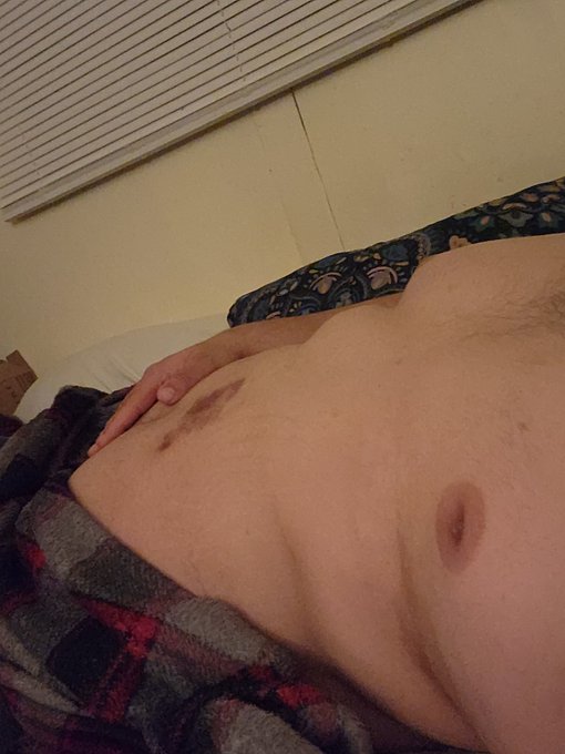 (TW:burn scar) fuck it posting scared tummy off private 🫣🏃&zwj;♂️ https://t.co/6CNKMWZWd1<a href="/tag/nsfwtwt"class="tags"><span>#nsfwtwt</span></a>