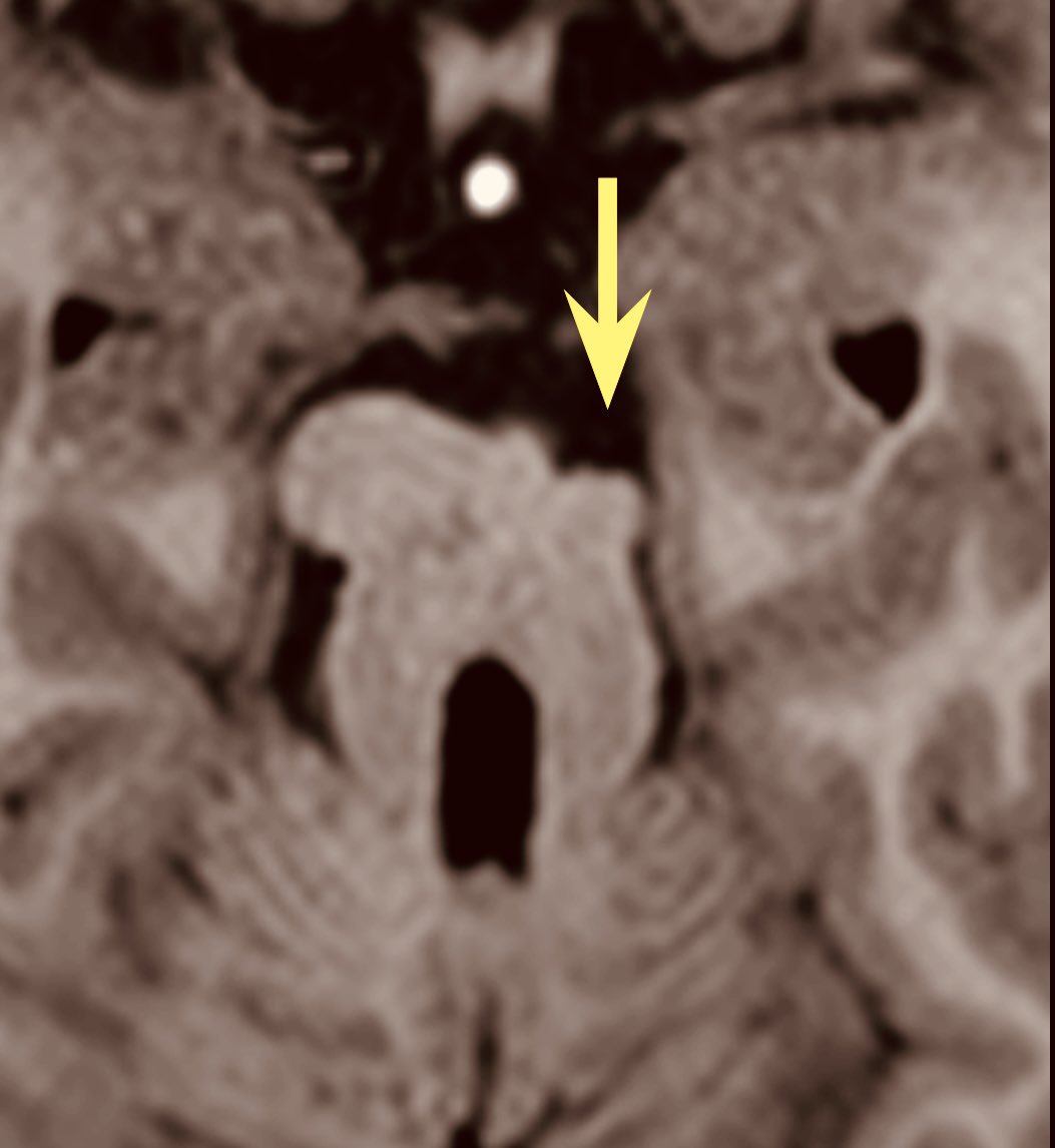 Tip of the day 💡: The molar tooth in Jouberts Syndrome could be decayed! The decay sign is secondary to displaced corticospinal tracts mostly. Remember- every “tooth” can be decayed!