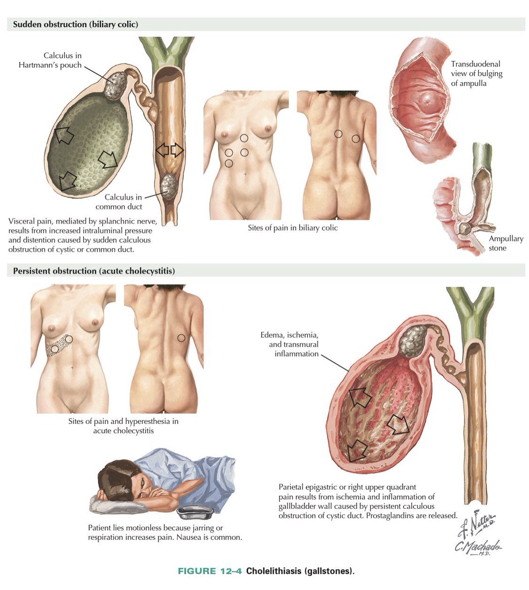 drkeithsiau's tweet photo. Differences between biliary colic vs acute cholecystitis (via Netter’s) https://t.co/xyyJawSdtl