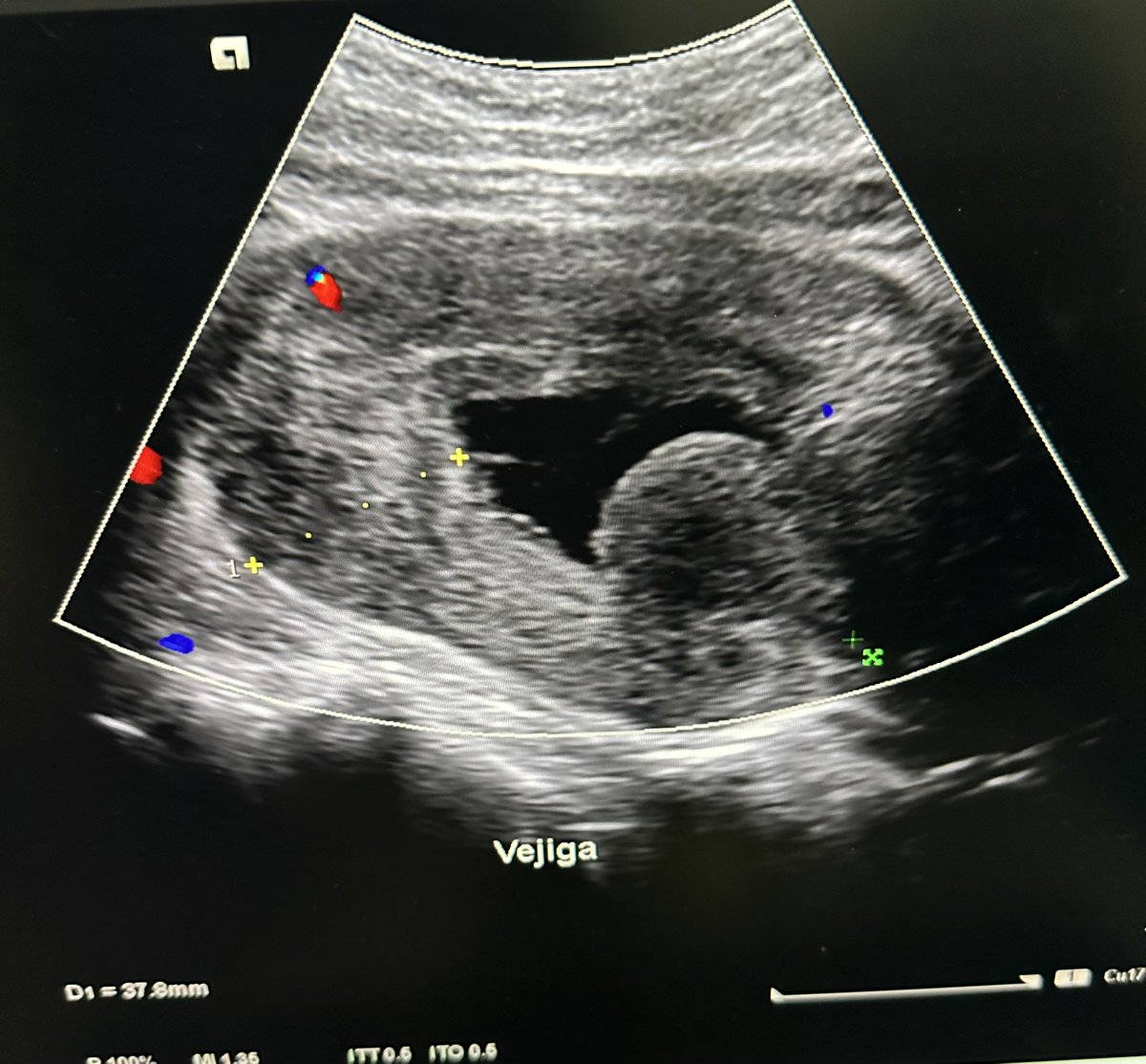 UroBruce's tweet photo. Tomorrow #holep number 312, a 164-grams prostate with the thickest bladder I've seen in my life 😳. 

Any suggestions in the treatment of bladder function after surgery?

#aeep #eep #urobruce https://t.co/D6blgtTsoH