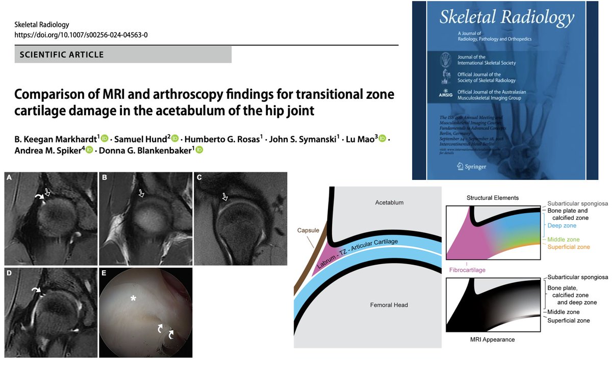 Congrats to Keegan Markhardt & the rest of the team on our publication! Acetabular transitional zone cartilage can be difficult to interpret on MRI – arthroscopic correlation can help better understand what to expect after MRI! #hippreservation @UWiscRadiology @wiscorthopedics