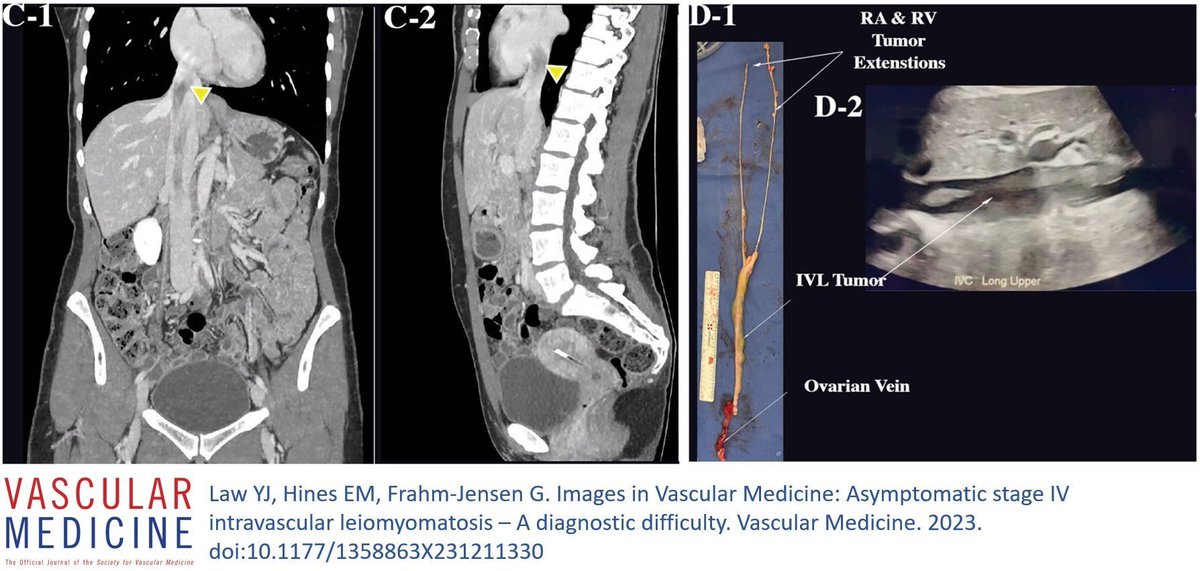VascularMedicine (@vmj_svm) on Twitter photo An asymptomatic 48-year-old is diagnosed with an inferior vena cava thrombus. After 6 months of anticoagulation, surgical resection revealed intravascular leiomyomatosis. Learn about this rare entity and others in these #ImagesinVascmed.
<a href="/gertfrahmjensen/">Gert Frahm-Jensen</a>
buff.ly/47wdzgx An asymptomatic 48-year-old is diagnosed with an inferior vena cava thrombus. After 6 months of anticoagulation, surgical resection revealed intravascular leiomyomatosis. Learn about this rare entity and others in these #ImagesinVascmed.
<a href="/gertfrahmjensen/">Gert Frahm-Jensen</a>
buff.ly/47wdzgx