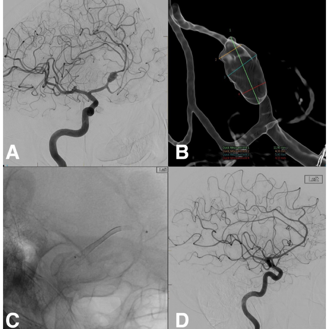 🧠 Don’t miss Laetitia de Villiers and @halrice discussing 4th gen #PED with Dr. Peter Kim Nelson and @esamaniego discussing Tigerretriever to treat AIS with underlying athero with @majidishahram. Along with @DrAltschul as part of @JNIS_BMJ journal club: 2/1 4-5PM EST