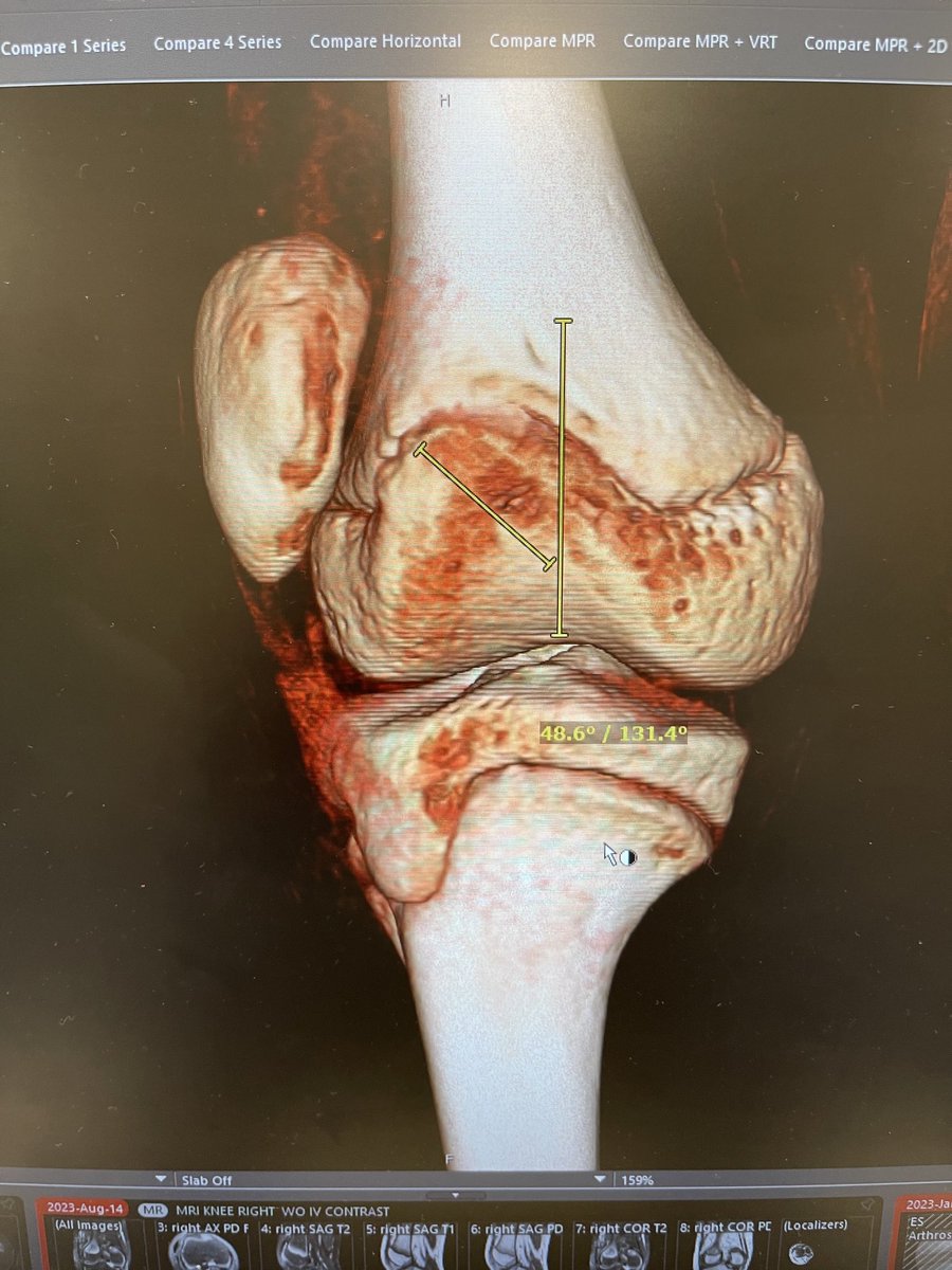 Get the “lay of the land” (Schneble) before operating. Only 3D allows this. Yu, K - Arthroscopy Techniques 2023 open access. Consider this entry point- transition point angle. Entry point is the center entry zone where patella enters the trochlea