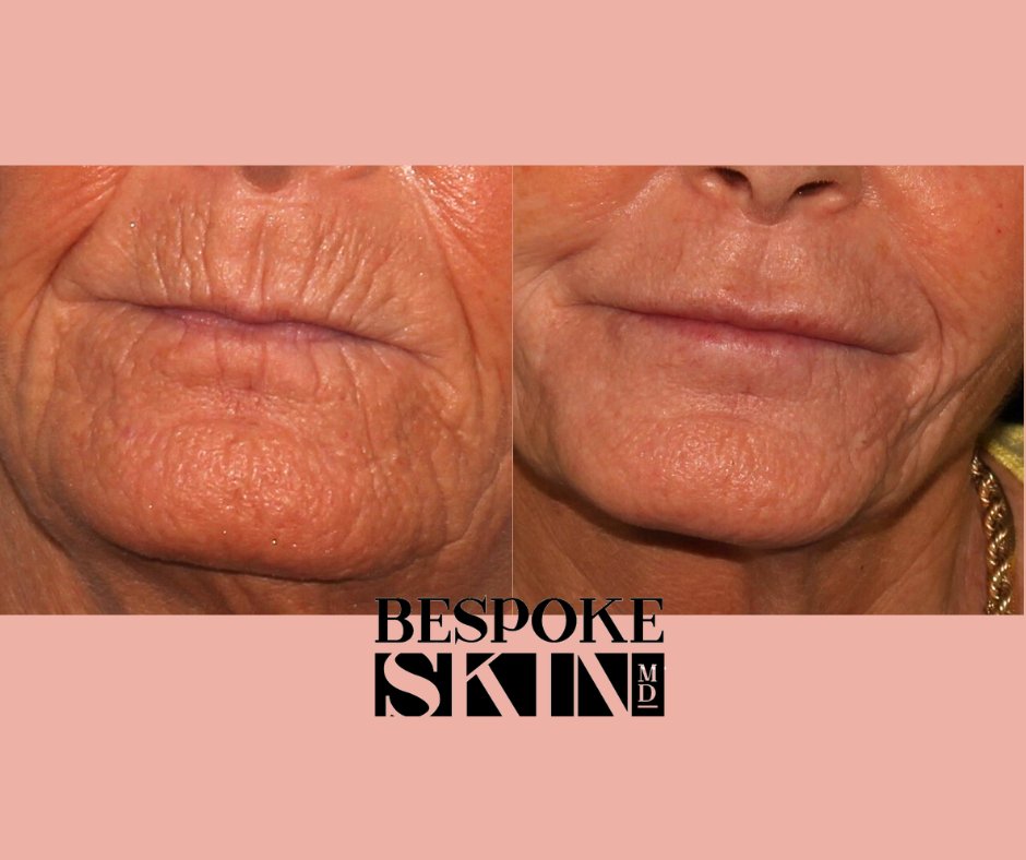 md_bespoke's tweet photo. 🌸We used a combination of Plexr Plasma to the deep lines plus small amount of Teoxane Kiss and Teoxane RHA 1 filler to take 20 years away!
📍Bespoke Skin MD, Kingston
#ygk #kingston #plasticsurgeon #liplines #barcodelines #kingstonontario #plexr #teoxane #filler #rejuvenate https://t.co/EwkwyQ314a