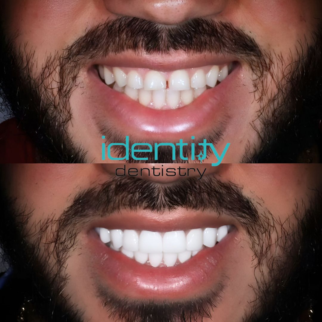 Enhance your smile with dental veneers! ✨Consult with us today ☎️

For bookings and/or more info:
🌐identitydentistry.com.au
📞(02) 6248 5692

#IdentityDentistry #MakingSmiles #TopDentist #BeautifulTeeth