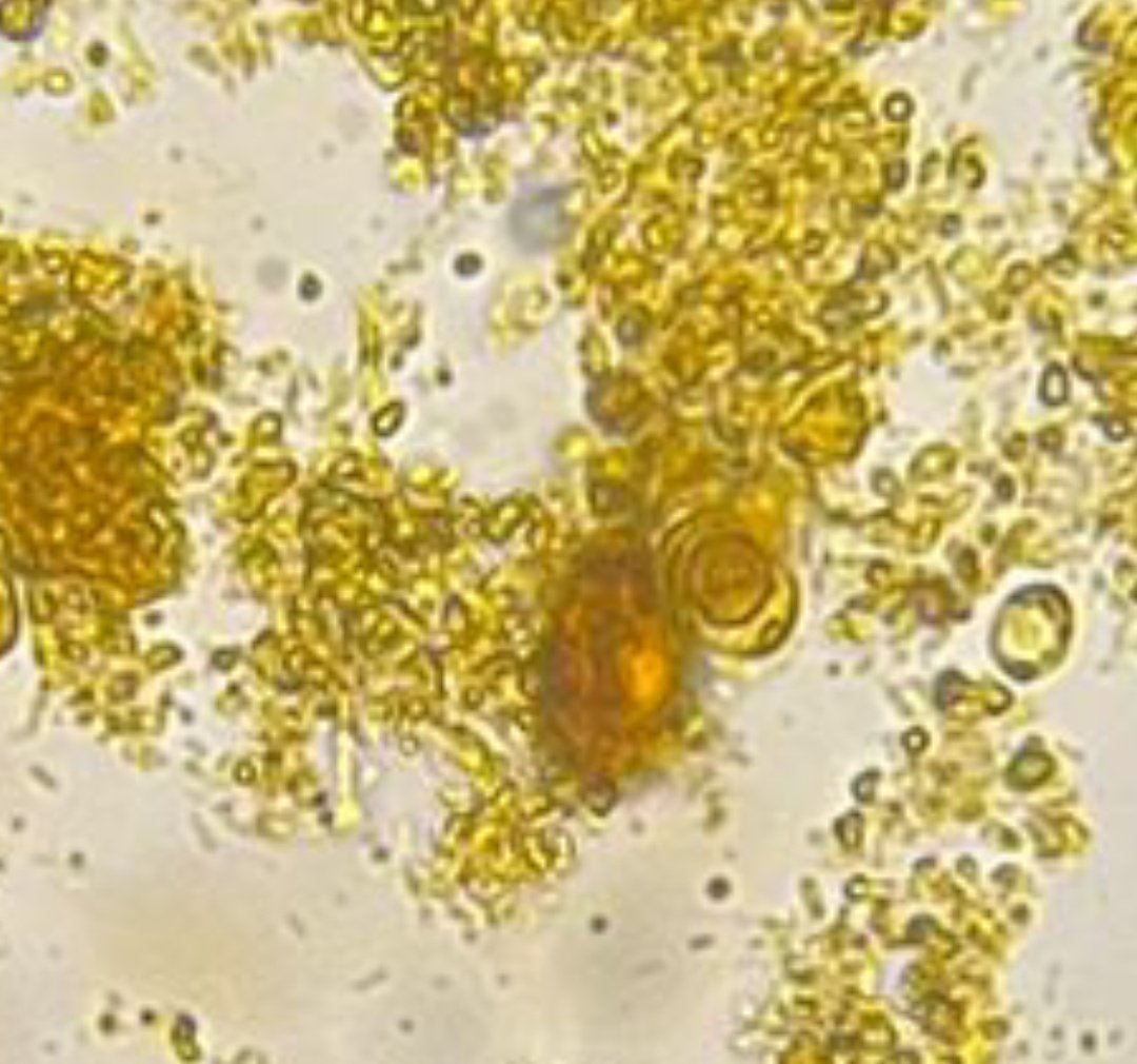 Blastocystis homonis in stool