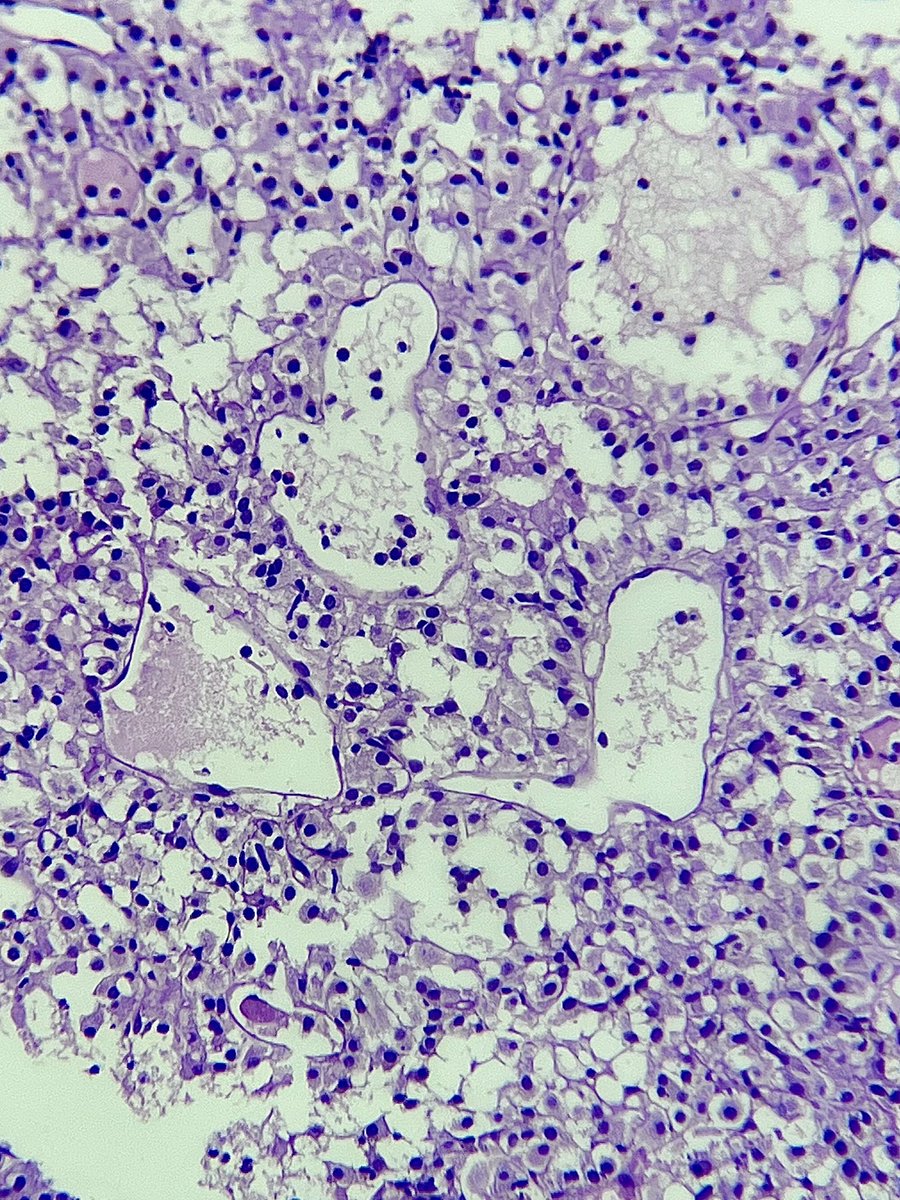 Immanuel_Paul30's tweet photo. โDiplomacy is like jazz: endless variations on a themeโ
50s/F liver mass
Thoughts ?
#PathTwitter #impath https://t.co/gfReOeTQ5g