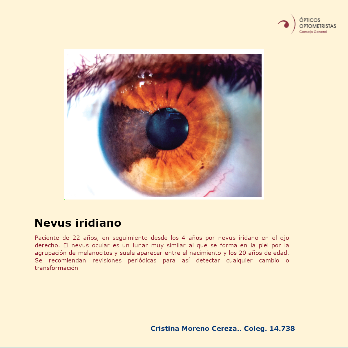 Cgcoo_es's tweet photo. 🏆📸#ConcursoFotografiaCientificaOcular | Foto seleccionada para optar al premio Carlos López H. de fotografía ocular Topcon España
#LaGacetaCGCOO #Gaceta597 #nevus #iridiano https://t.co/hF4wSIBwts