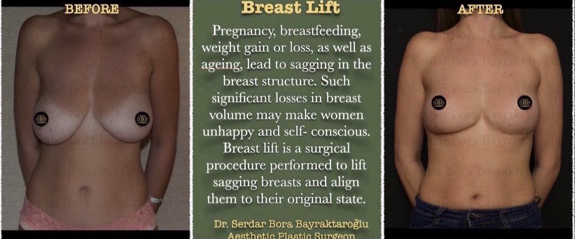 BREAST LIFT

regain your self-confidence with breast lift

#clinicsbb #clinicsbbinternational #aestheticsurgery #plasticsurgery  #plasticsurgeon #serdarborabayraktaroglu #beforeafter #breastlift #surgery #aesthetic #new #breastaesthetic
