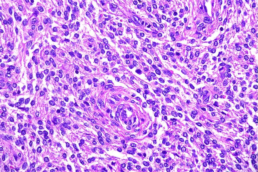 GeronimoJrLapac's tweet photo. Ovary tumor. Dx and one IHC marker?
#pathplus #pathology #pathologist #gynpath https://t.co/efODZAn6QR