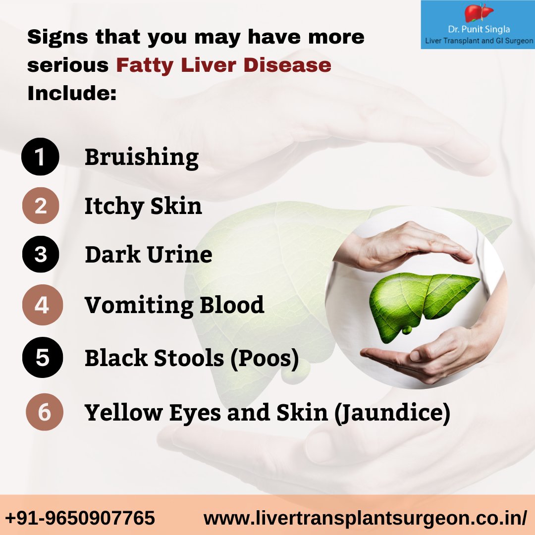 Signs that you may have more serious Fatty Liver Disease Include:

#punitsingla #livertransplantsurgeron #liversurgeon #liverdoctor #livertransplant #liverdisease #fattyliver #fattyliverdisease #liverdiseasesigns