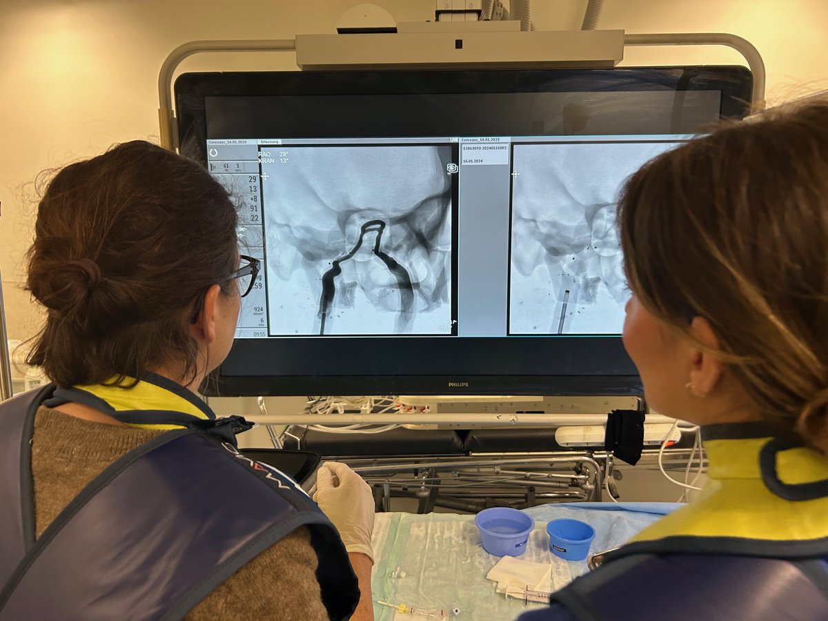 First <a href="/CereVasc/">CereVasc</a> eShunt deployment in 🇪🇺 (using a <a href="/JacobsInstitute/">Jacobs Institute | Nonprofit Med-Tech</a> model) and #HANNES, done my <a href="/asteroid2706/">Astrid Grams</a> and <a href="/HelenaG_Neuro/">Helena Guerreiro</a> in Hamburg Zeumer Lab. Very impressive device.