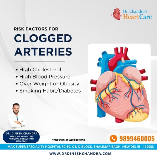 Clogged arteries can lead to serious health problems, including heart disease and stroke. 
For More Information
Visit the Website: drdineshchandra.com
Call @ 9899460005

#heartsurgeon #drdineshchandra #hearthealth #unhealthyheart #heartcare #CloggedArteries #HeartHealth