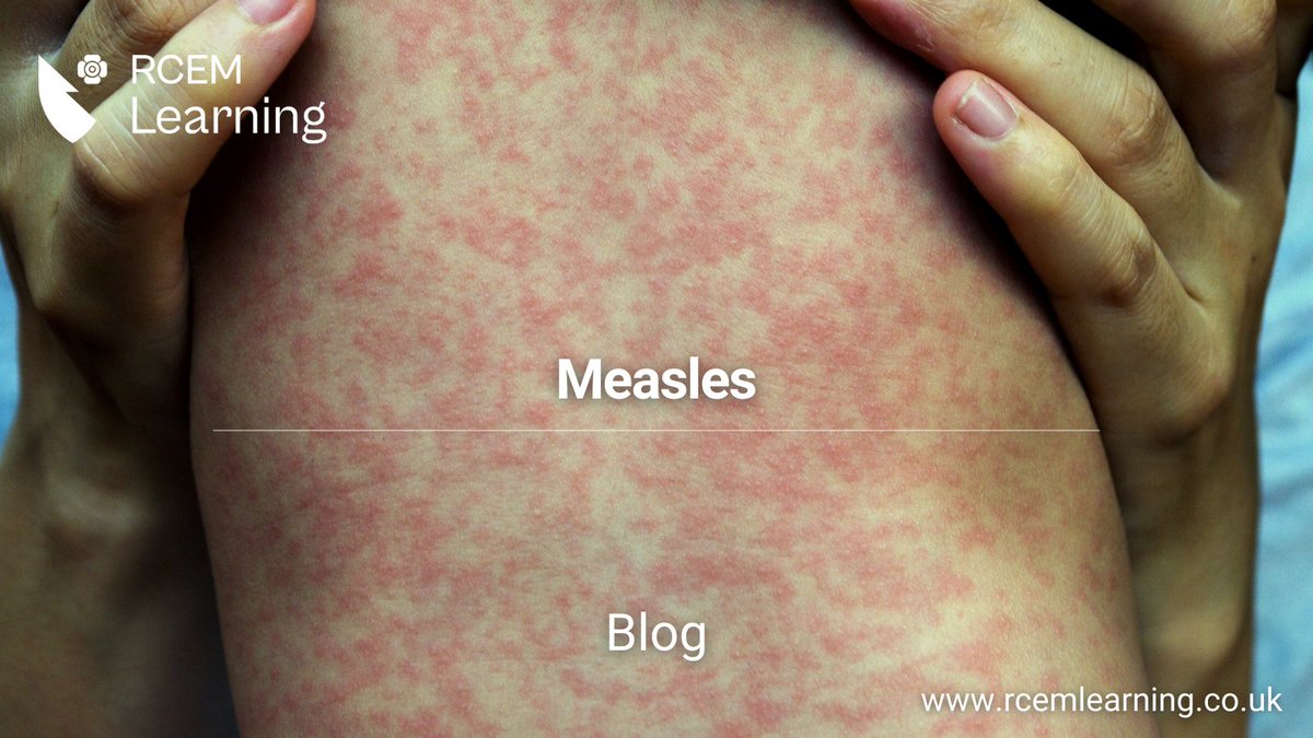 NEW: With vaccination rates at their lowest in 10 years, measles is back in our departments and has to be in our differential diagnosis list. Read more in our latest #Blog here: rcemlearning.co.uk/foamed/measles/