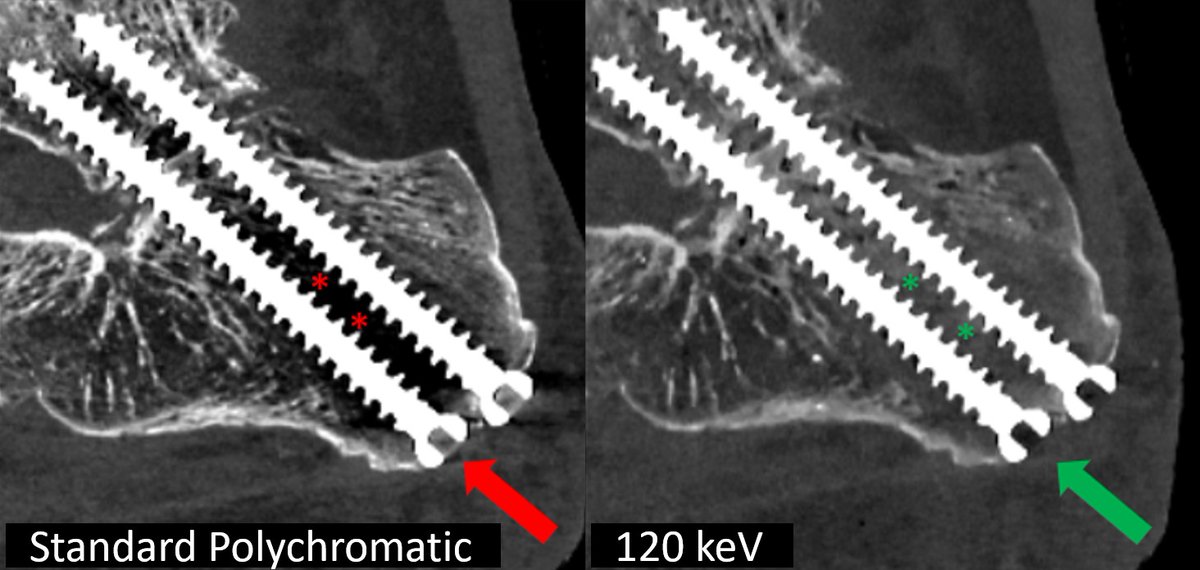 Is #PhotonCountingCT becoming the new standard for assessing #BoneHealing? 👉 Check out our new #OpenAccess study doi.org/10.1097/RLI.00… Photon Counting CT significantly improved the visualization of bone healing next to metal implants @derbalgrist │@BalgristCampus │ #MSKrad