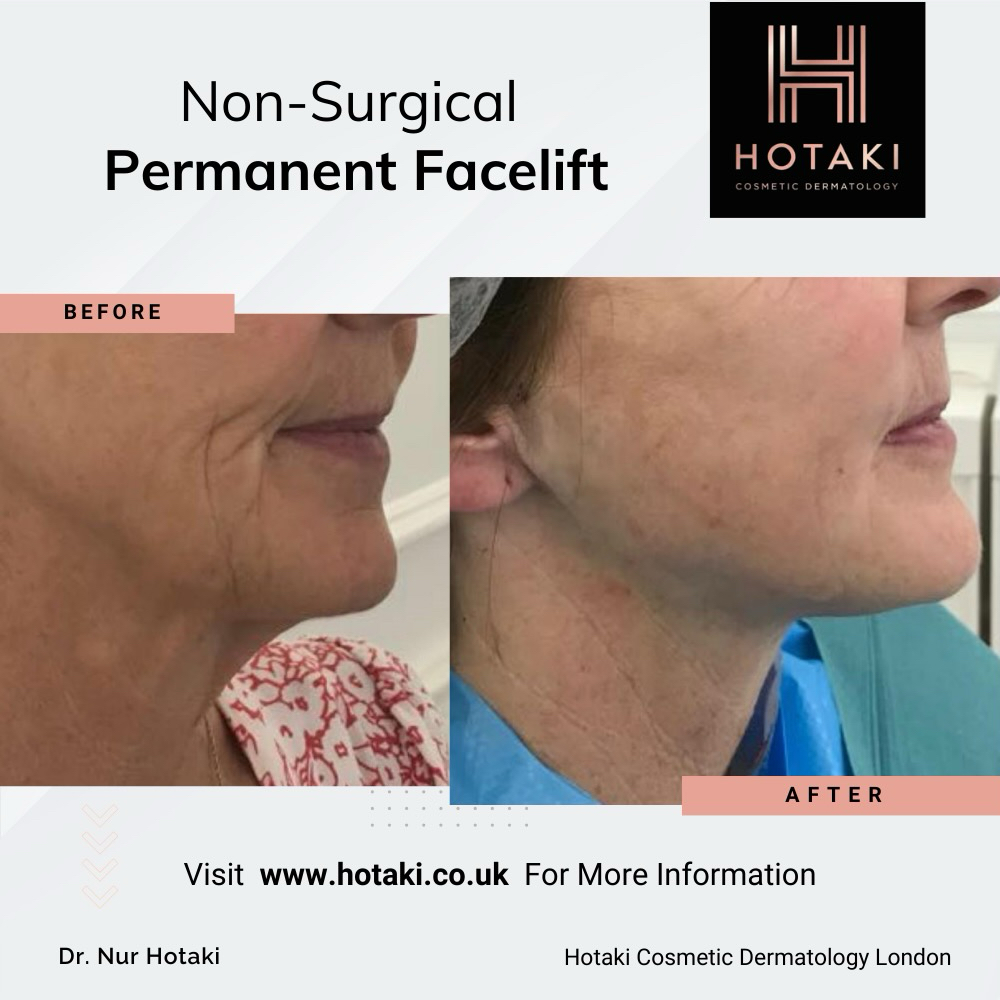 #DrHotaki #HotakiLondon #NonSurgicalAesthetics #AestheticTreatment #HotakiCosmeticDermatology #NonInvasive #NonSurgical #LowerFacelift #NonSurgicalLowerFacelift #NonSurgical #NonSurgicalFacelift #FacialRejuvenation #LowerFacelift #facelift