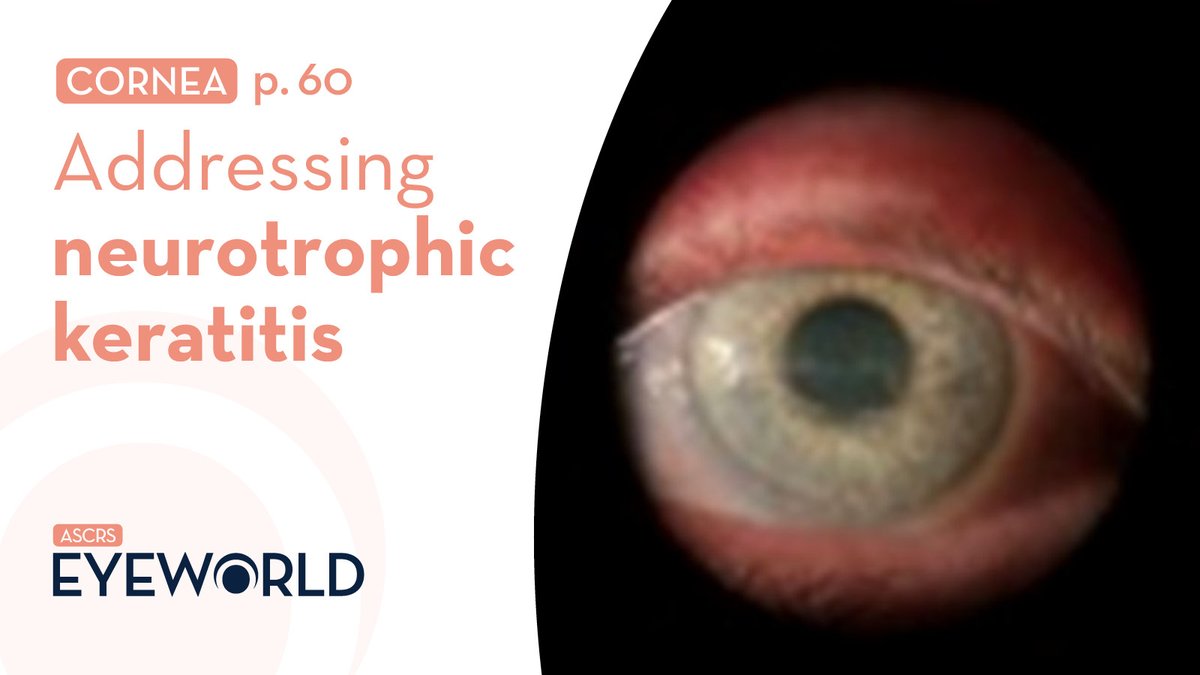 ASCRStweets's tweet photo. Neurotrophic keratitis, though rare, might pop up in your practice more than you think. Learn the diagnostic signs and how to manage these cases in this article with Francis Mah, MD, and Lisa Nijm, MD, JD, at https://t.co/AwYWSh1ZOt #EyeWorldMagazine https://t.co/5frMbVIwFL