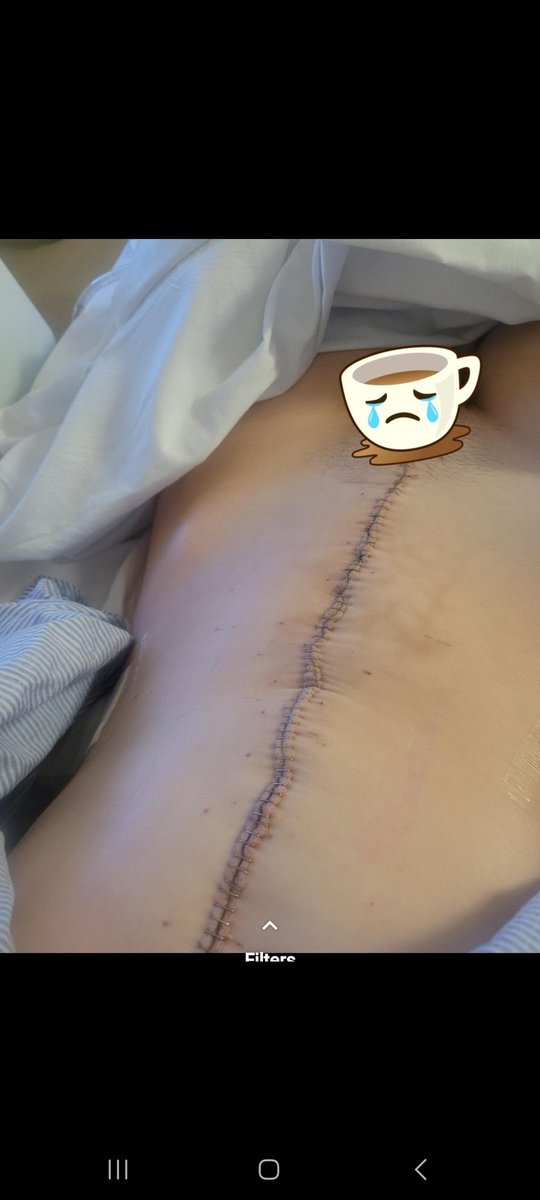 Justfayelouise's tweet image. I had a total of 69 staples after CRS HIPEC surgery Basingstoke saved my life the peritoneal Malignancy institute. I&apos;ve had to lose 8 organs and 10kg in weight but they made me cancer free which I thought was impossible #pseudomyxomaawarness #pseudomyxoma #appendixcancer #cancer