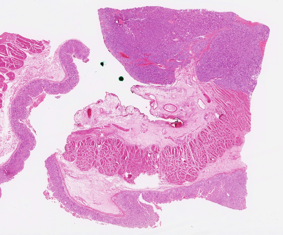 cygupath_md's tweet image. Gastroblastoma is a GLI1 (or EWSR1) translocation tumor that one reads in textbooks but may never encounter in practice. Surely I haven't seen another one since I graduated. #surgpath #pathX #pathtwitter #pathology #pathologists #stomach #cancer #GIpath
