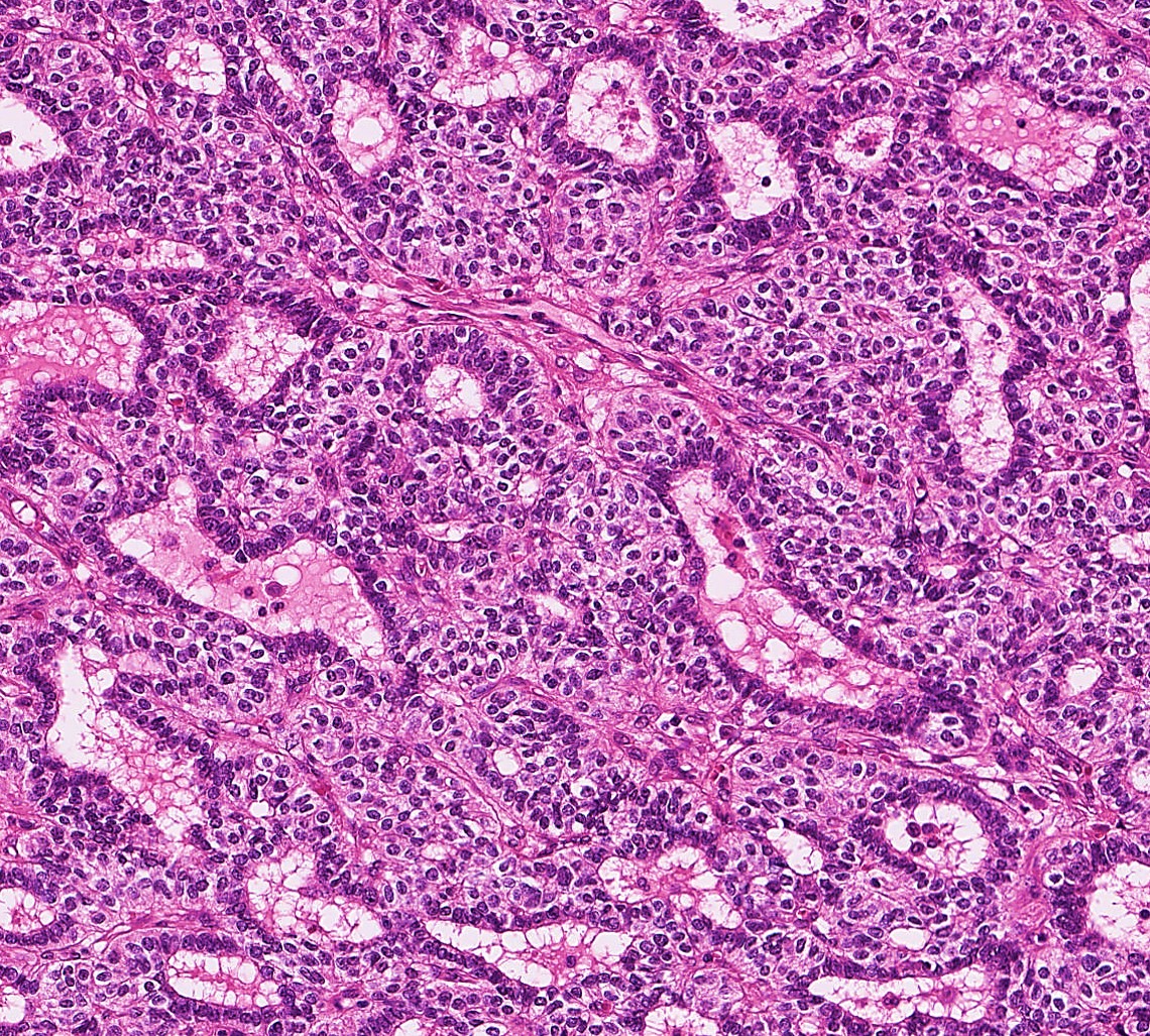 cygupath_md's tweet image. Gastroblastoma is a GLI1 (or EWSR1) translocation tumor that one reads in textbooks but may never encounter in practice. Surely I haven't seen another one since I graduated. #surgpath #pathX #pathtwitter #pathology #pathologists #stomach #cancer #GIpath