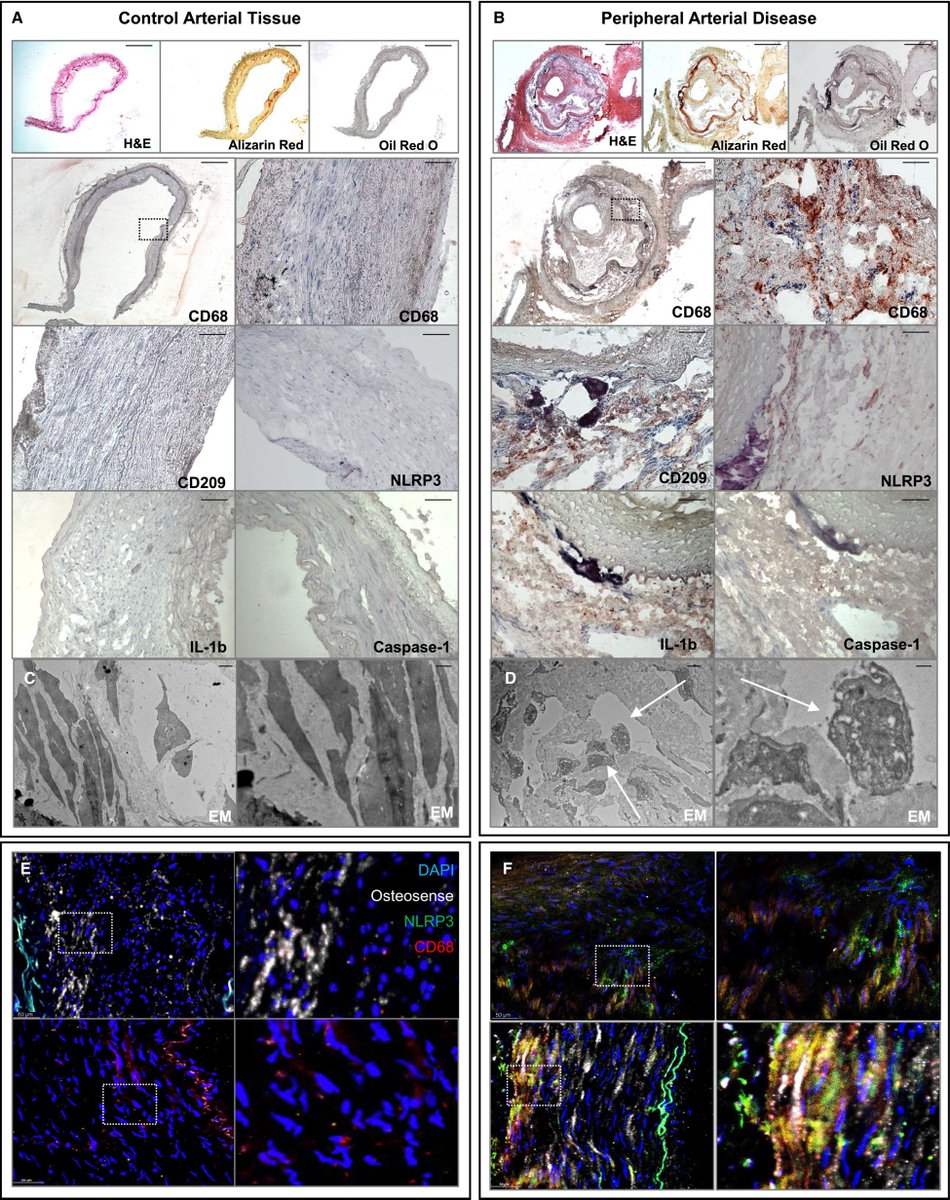 @NiruKrishMD @MaryWhooley @schopfermd @Aziz_Nagar From Bartoli‐Leonard et al: NLRP3 Inflammasome Activation in Peripheral Arterial Disease @FrannyBartoli @AikawaElena @mandyturner_ @toleafgirl ahajournals.org/doi/10.1161/JA…