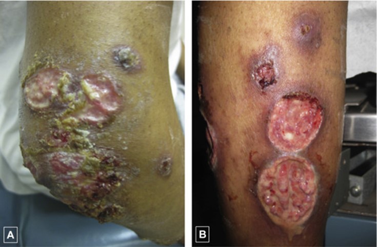 “‘Malignant #syphilis is a rare, severe form of secondary syphilis, characterized by cutaneous ulcers with central necrosis that a black-brown rupioid crust may accompany.” Read more in #DermWorld Insights and Inquiries. aad.org/dw/weekly/janu…