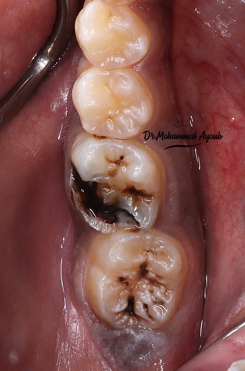 i_edx's tweet photo. ⁃Caries removal followed by indirect pulp capping with MTA
⁃Cusps build up with composite🦷
⁃Follow up https://t.co/9vi1XjcSeT