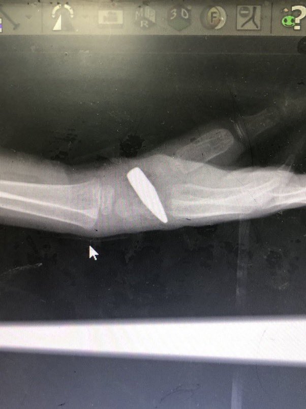 swilkinsonbc's tweet image. I had to get a bullet out of a 5yr-old boy in the emergency room: he was shot from an israeli aircraft at an UNRWA school @IssamAboim64917