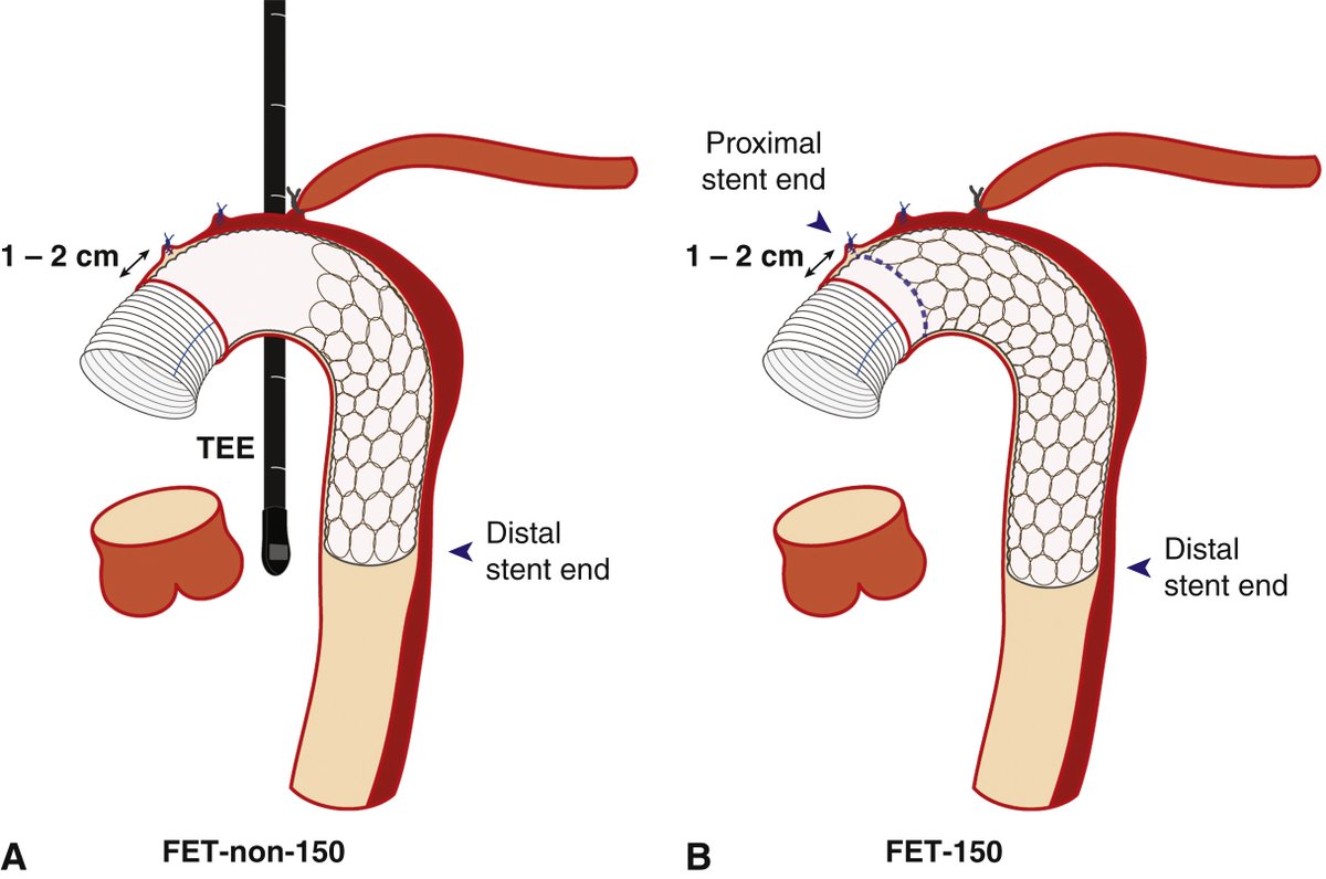 AATSHQ's tweet photo. See the results of this #JTCVS investigation on the optimal stent length and distal positioning of frozen elephant trunks in patients with type A acute aortic dissection (#TAAD): https://t.co/IkF20CS2YQ https://t.co/KgCiwgI4mo
