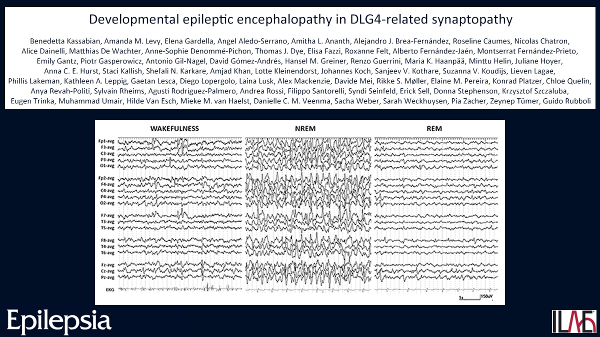EpilepsiaJourn's tweet photo. Key point: A subgroup of individuals with DLG4-related synaptopathy have DEE.
https://t.co/2279PYzs20

#Epilepsy #ESES #DEESWAS #SHINEsyndrome #PSD95 @IlaeWeb @epilepsiajourn @WileyNeuro https://t.co/QUXlpVpNmF