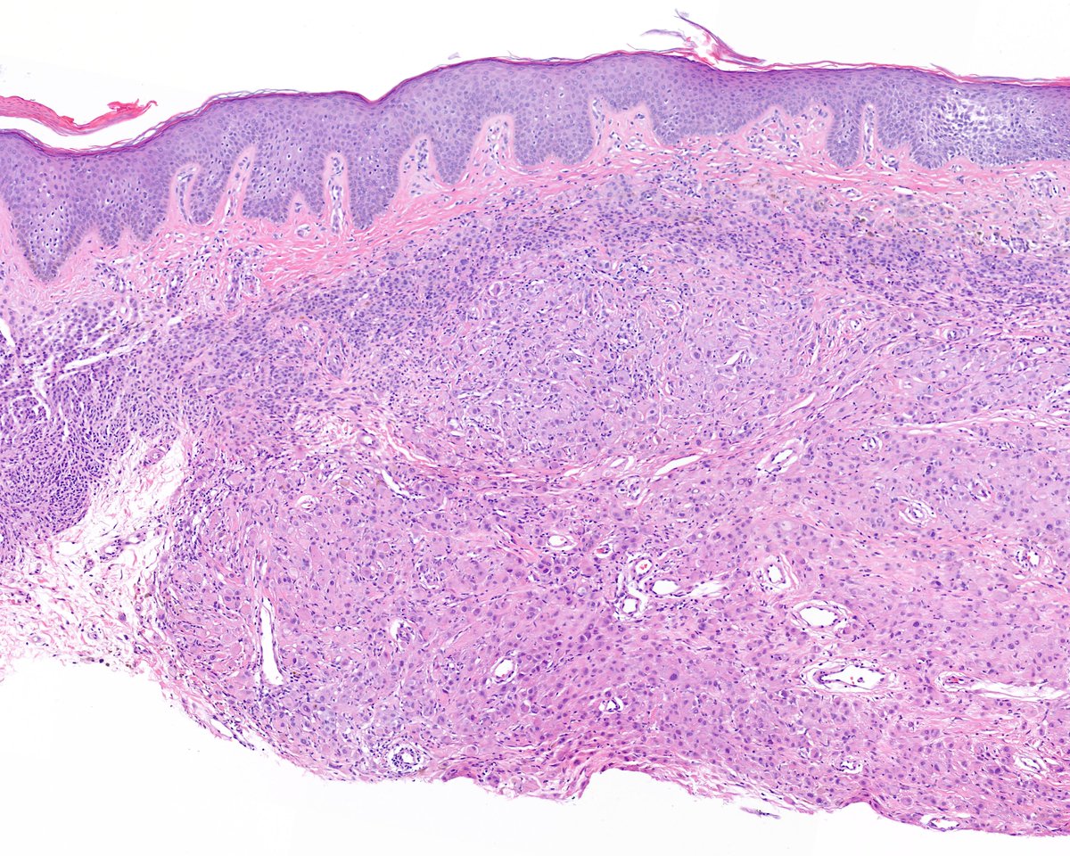 Combined BAP1-inactivated melanocytoma of the Meyerson type