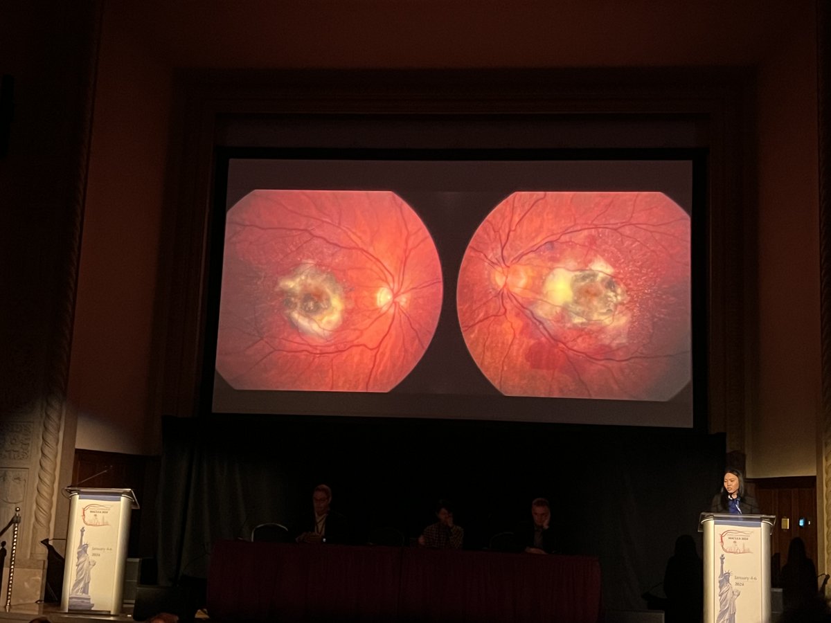Watch for CNV in patients with oxalate retinopathy in the setting of primary hyperoxaluria type 1–intravitreal injections of anti-VEGF can help, according to Victoria Ly, MD, MPH, who presented the case. #ACRC2024 #Retina