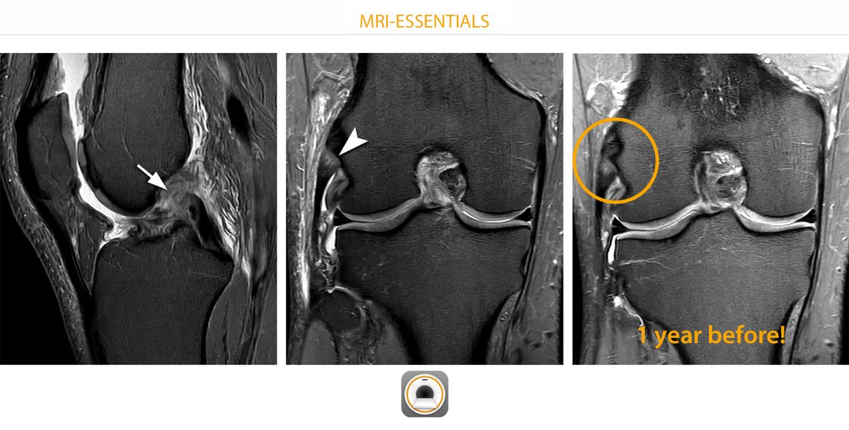EssentialsMri's tweet photo. LCL knee - always a pitfall! Left: Ski injury on New Year's Day, tear of the ACL (arrow). Center: A partial tear of the lateral collateral ligament could also be suspected (arrowhead). But: It looked exactly the same a year ago!
#mskrad #orthotwitter #radres #radiology https://t.co/hNd0y0DoXC