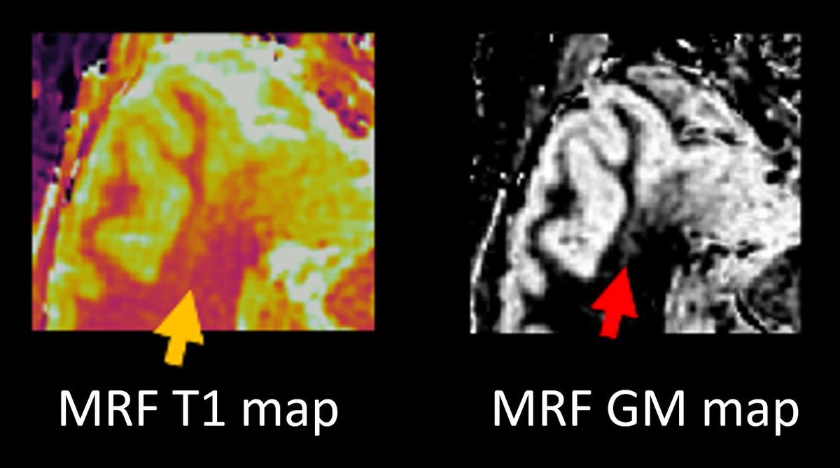 Irene Wang, PhD, FAES tweet media
