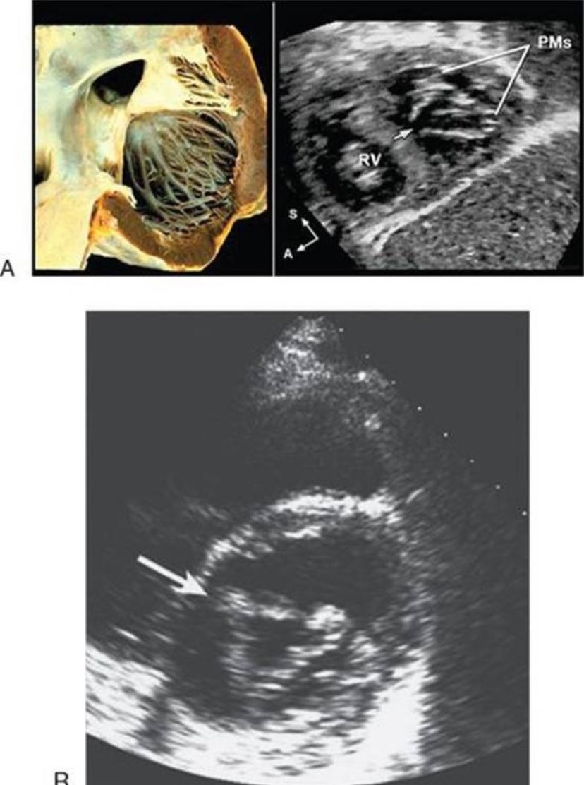 @ParrasJorge2 1/n It looks that there are 2AV junctions (T/M) & not 1 as in #AVSD; there is no Prim. ASD, position of LV papilar muscles are normal, there is no LVOT elongation & no unwedging of Ao valve. Must likely Dx is large #PMVSD w inlet-outlet extensión, w bidireccional shunt, & PHT.