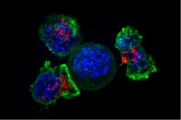 cancerscnews's tweet photo. 🔎 CCT2 was identified as a crucial regulator for #tumor progression, however, its exact role in epithelial #ovarian cancer remained unknown.
#CancerStemCell traits were evaluated by RT-PCR and 🧫 sphere-forming assay.
👉 https://t.co/4avWqePbDF https://t.co/CzlZZtWskj