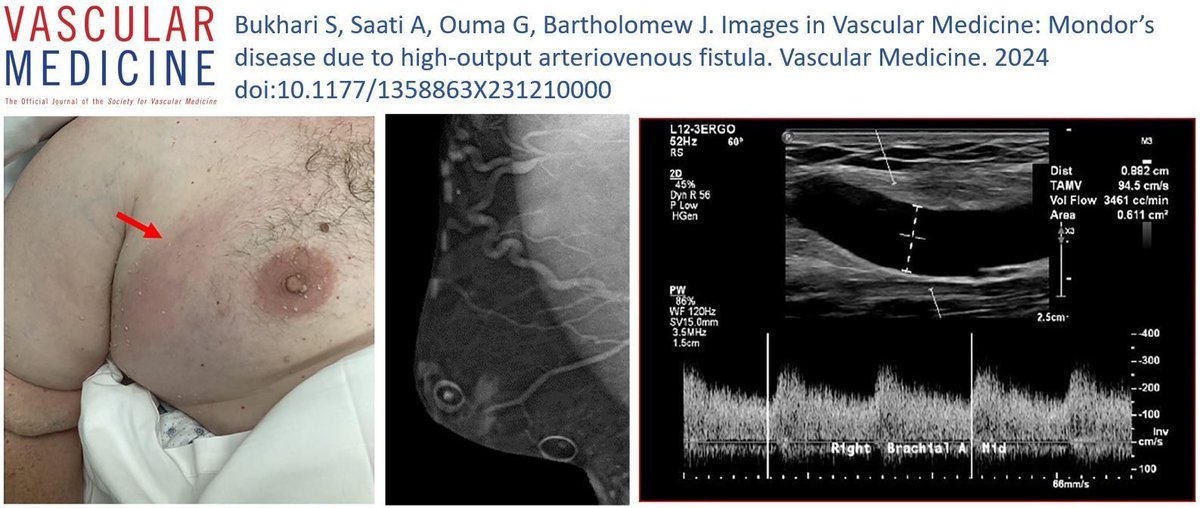 Online First! 55-year-old male with a history of an upper extremity arteriovenous fistula for dialysis, presents with right sided chest pain. Read about Mondor's disease in these #ImagesinVascMed by Bukhari, <a href="/AmmarSaati/">Ammar Saati عمار ساعاتي</a> and MSVM Dr. Bartholomew.