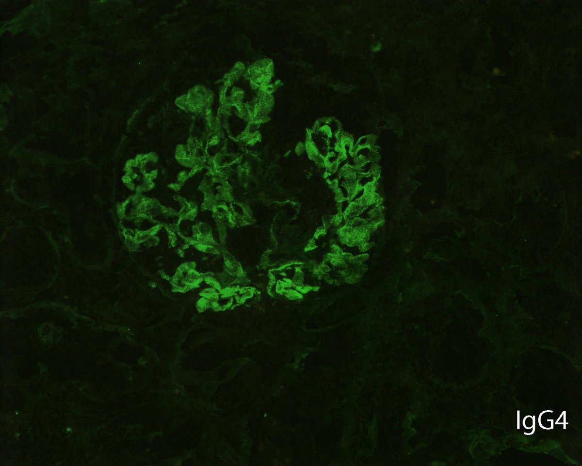 An interesting case of an overlap of anti-GBM disease with membranous nephropathy:  

Granular IgG staining along the glomerular basement membranes can mask underlying linear IgG staining and IgG subclasses can help.  Linear IgG staining is brought out with IgG1 with the MN IgG4.