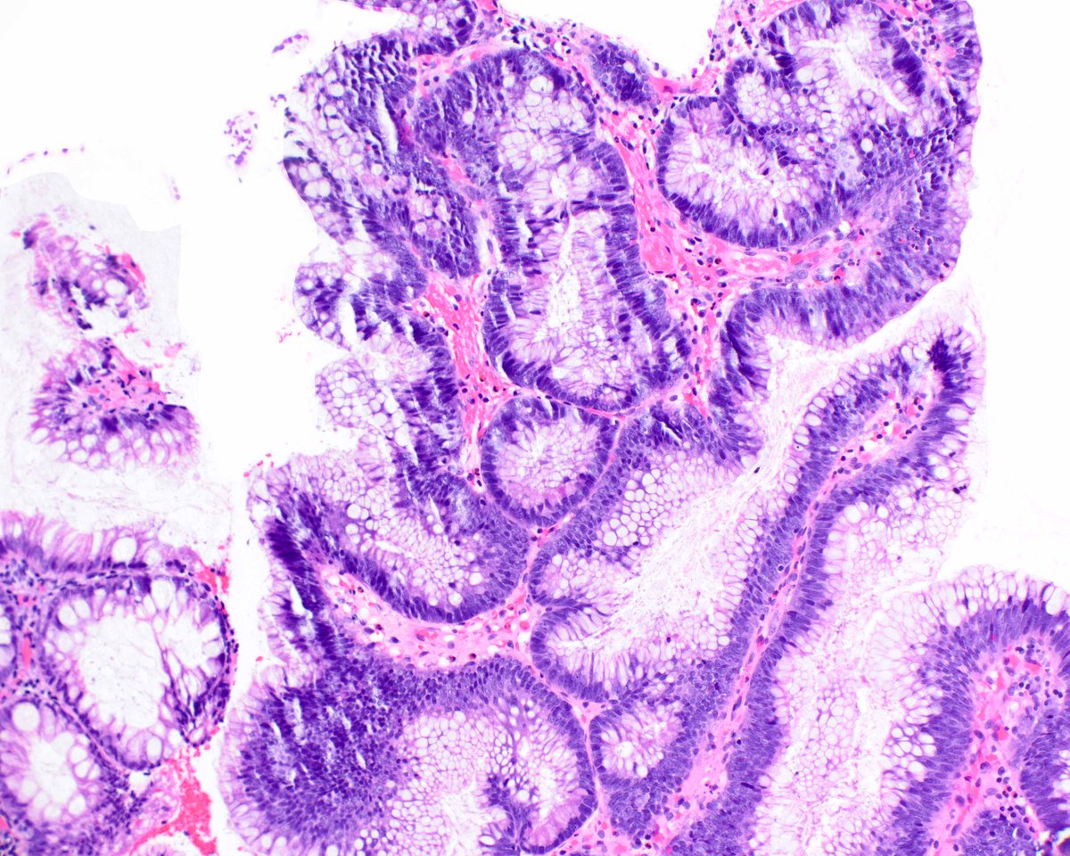 The colorectal polyps in juvenile polyposis (JP) feature striking multilobulation.  This patient's polyps also had  low-grade dysplasia, which cannot be distinguished from sporadic adenomas in superficial samples.  JP patients are at risk for colon adenocarcinomas. #umiamipath