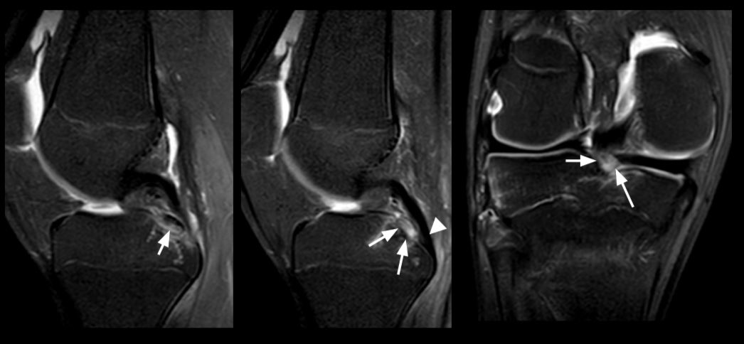 1st case of 2024 ! 

🔹14 y/o child, knee pain.

History of trauma (fall) - but not much info.

Check the CT - what do you think is avulsed here? 
(..)
Then check the MRI …. was your first impression right? 

▫️Medial meniscus posterior root avulsion fracture 

#mskrad