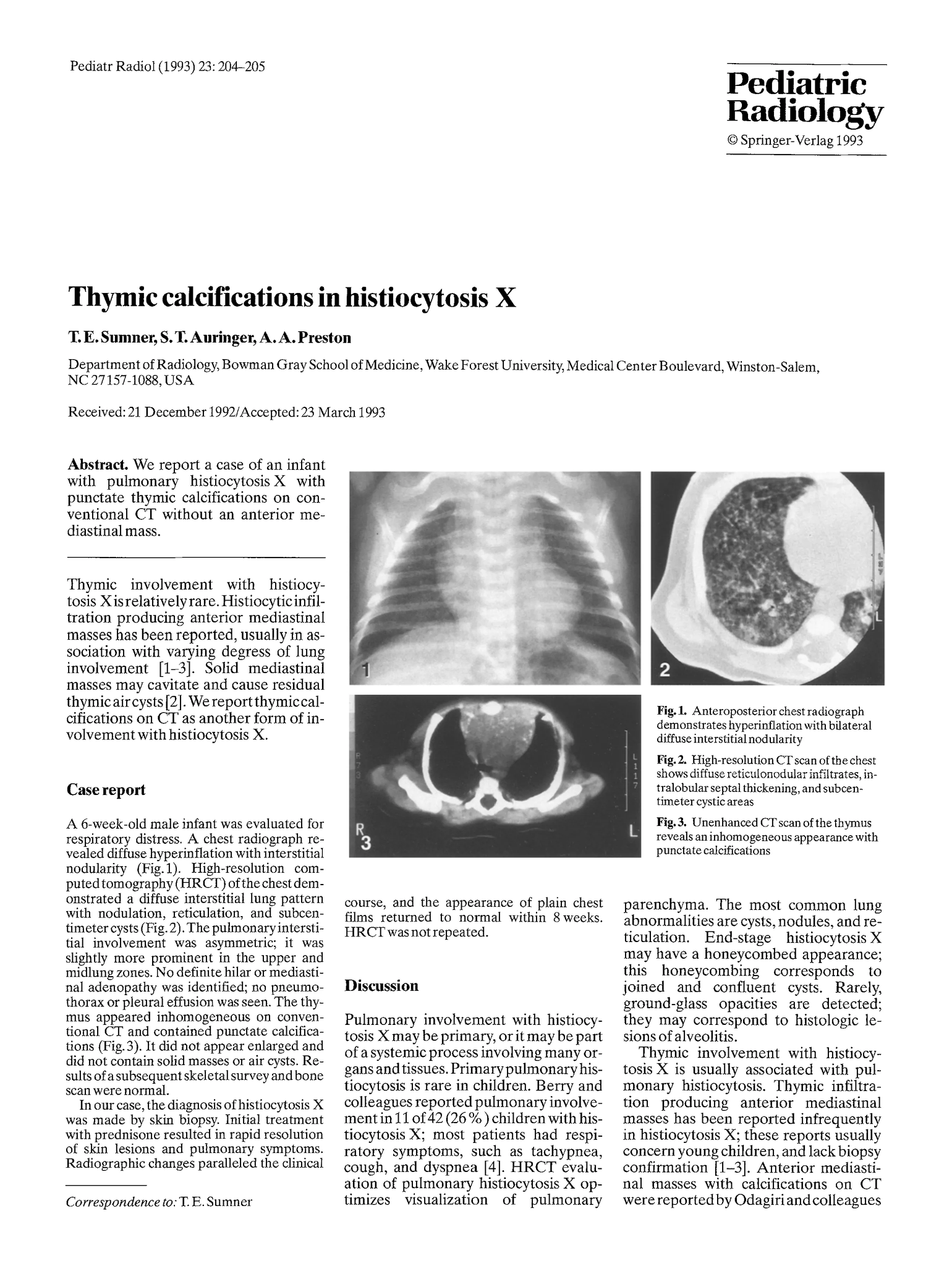 Life Sciences on X: Thymic calcifications in histiocytosis X  t.conMNjBsOq5G t.cobp09P0FTHA  X